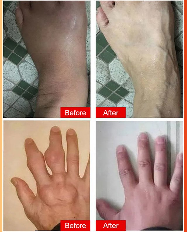 Gout Treatment Cream