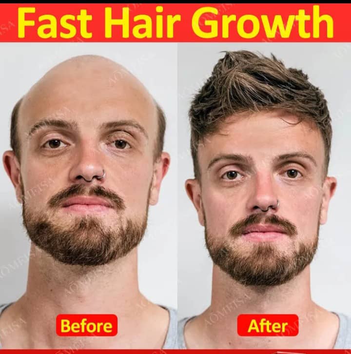 GroFast Herbal Spray--Restore & Grow Back Your Hair🔥🔥🔥