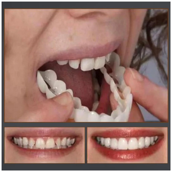 Magic Smile Teeth Brace 【Can eatting】100% non-inductive fit, no foreign body sensation！😁 (💥45% OFF) - 🔥HOT SALE🔥🎉