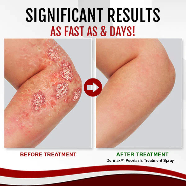 Dermax™ Psoriasis Treatment Spray